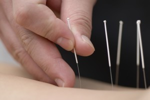 acupuncture-2